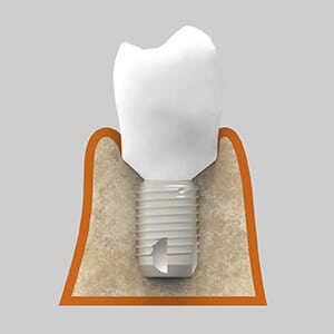 Implante dental corto