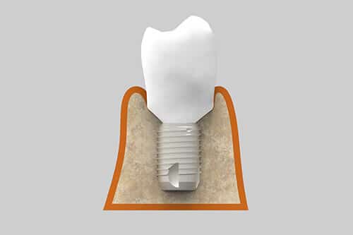 Implantes Dentales Cortos
