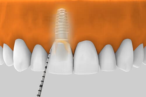 Mantenimiento de implantes dentales