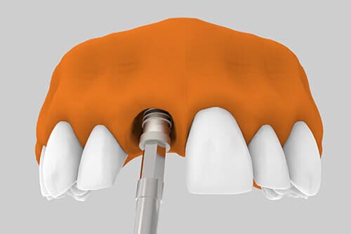 Implantes dentales postextracción