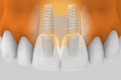 Implantes dentales Zona Estética