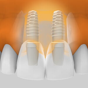 Implantes Dentales en Zona Estética