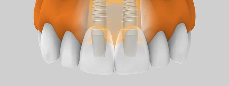tipos-de-implantes-dentales-interior-copia
