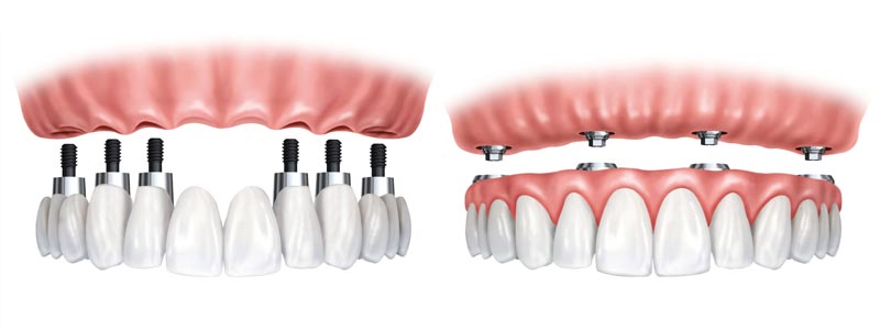 Prótesis sobre implantes dentales - Tipos de prótesis dentales