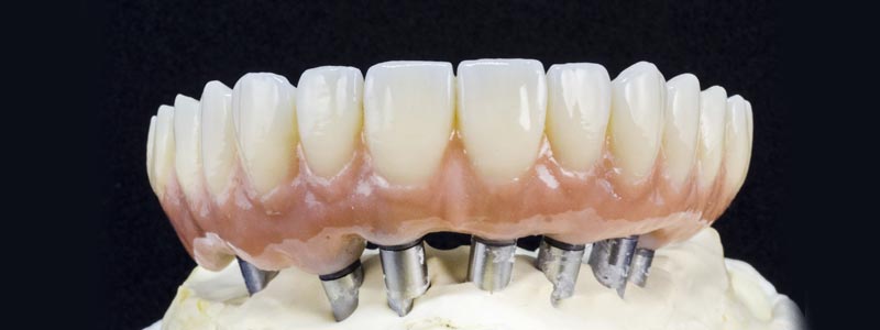 Prótesis sobre implantes dentales