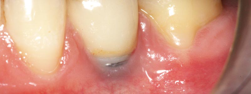 Cuidado de los implantes dentales - Periimplantitis