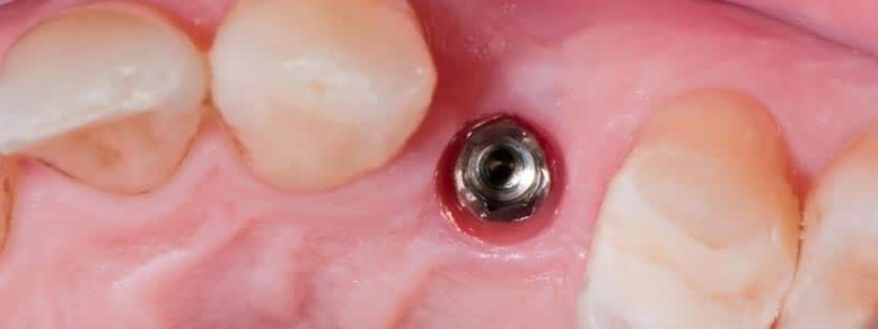 Rechazo de los implantes dentales
