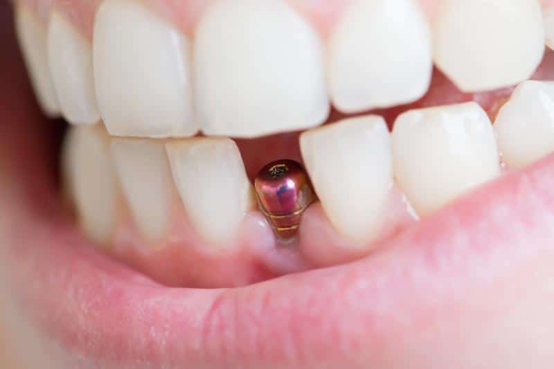 ¿Por qué se puede producir el rechazo de los implantes dentales? Respondemos a todas tus dudas.