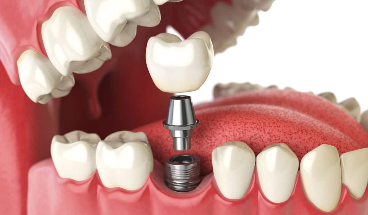 Técnicas de colocación de implantes dentales