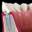 Osteointegración de los implantes dentales ¿en qué consiste?