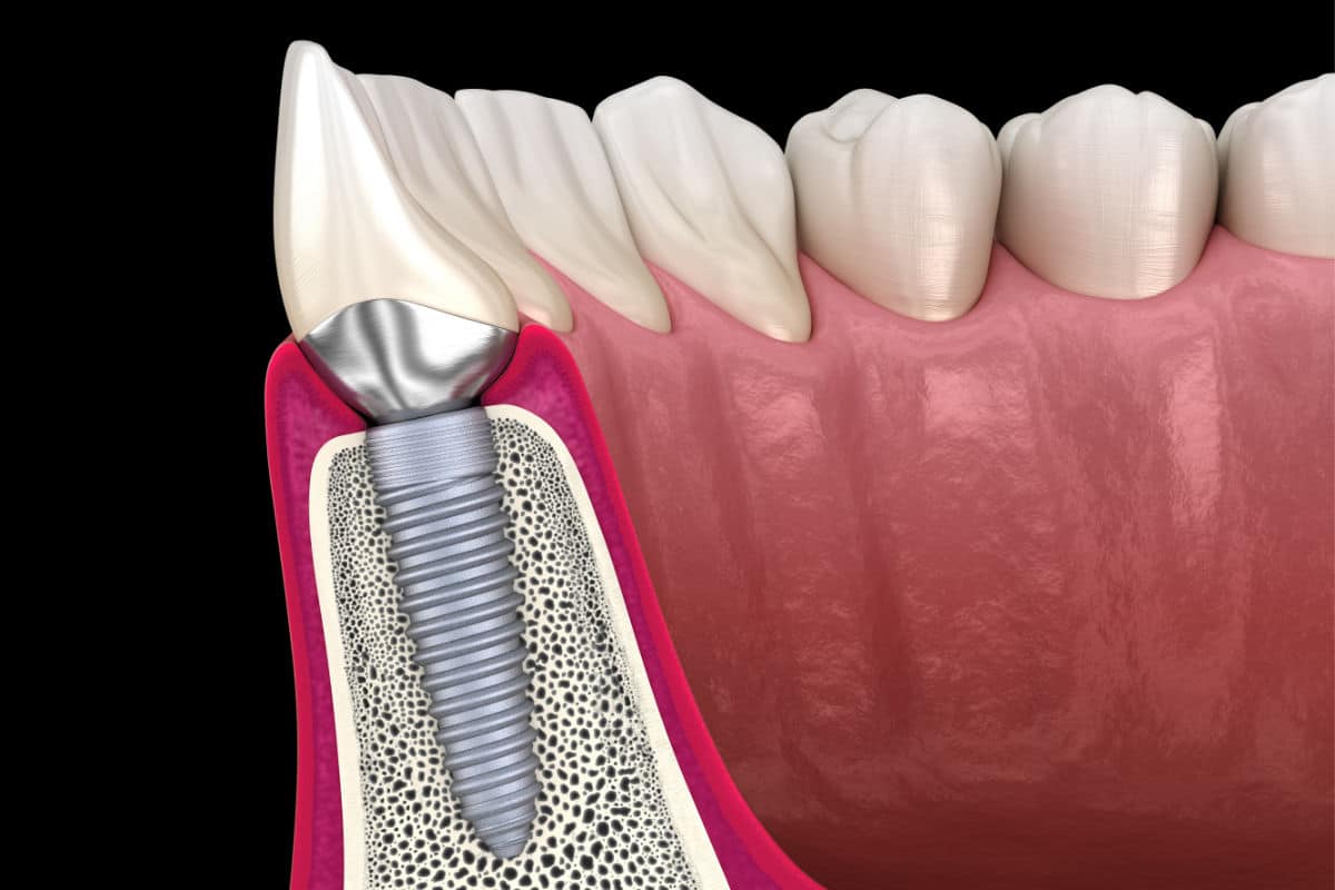 Osteointegración de los implantes dentales ¿en qué consiste?