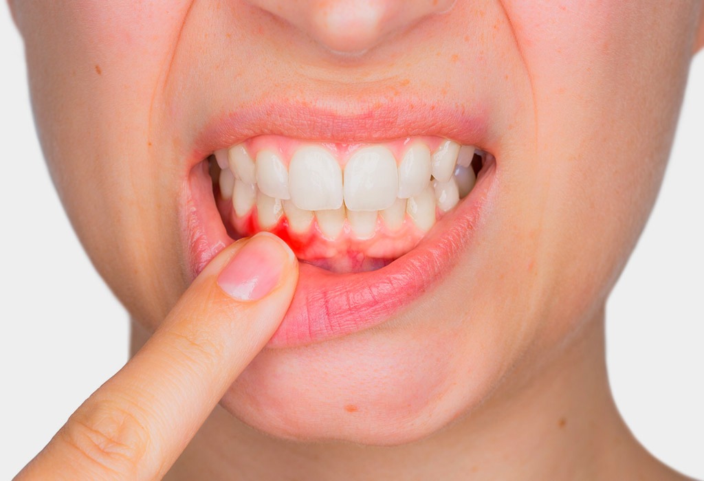periodoncia terrassa - Blog de Clínica Dental Badanelli